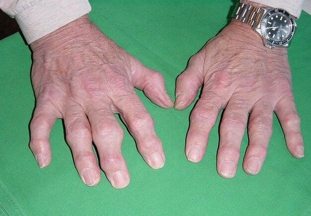 Artróza prstov