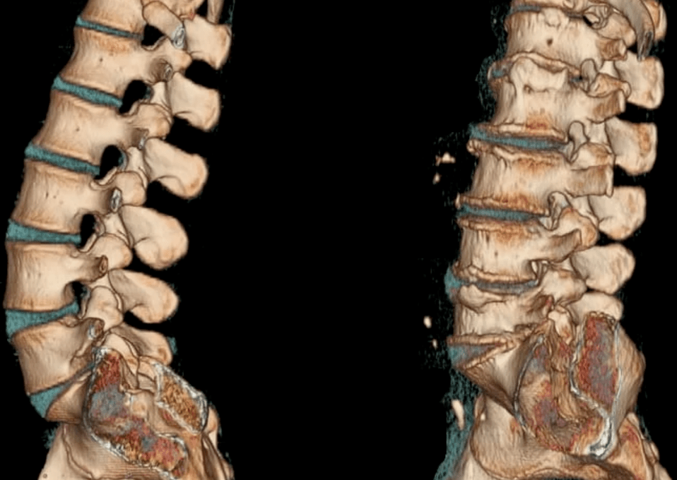 osteochondróza