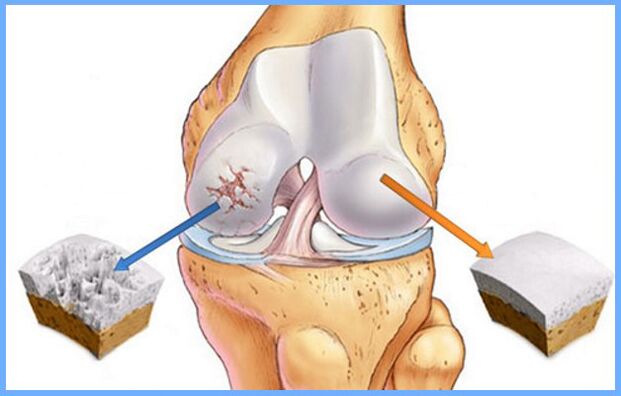 Normálny kolenný kĺb a postihnutý artrózou