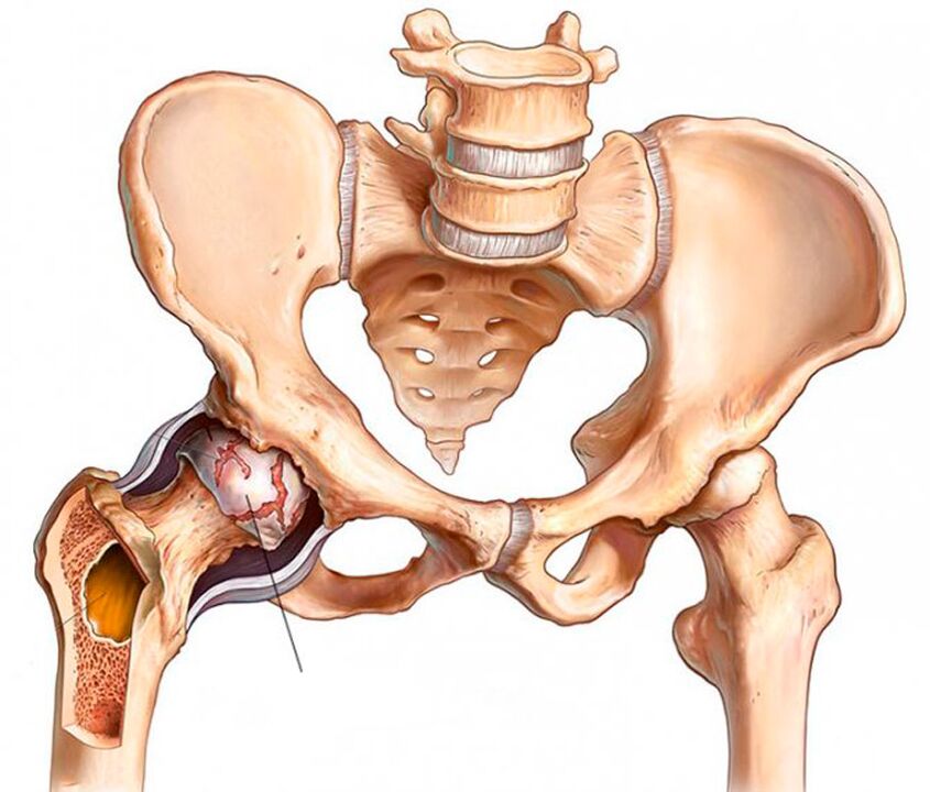 Artróza bedrového kĺbu