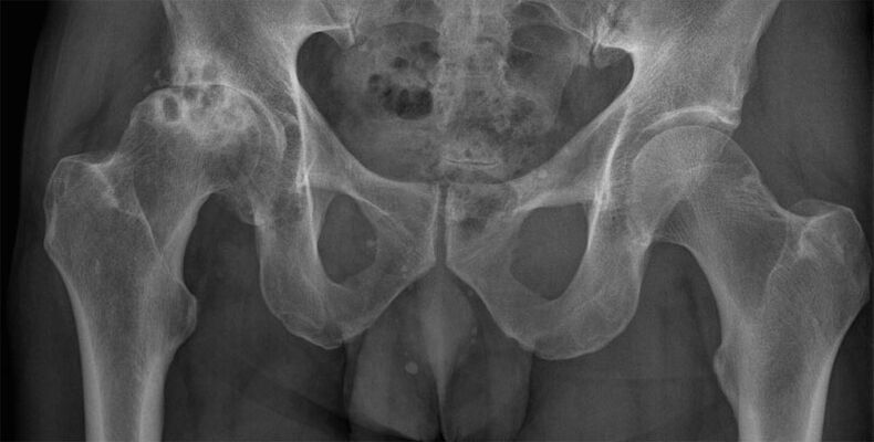 Deformujúca artróza bedrového kĺbu na röntgene