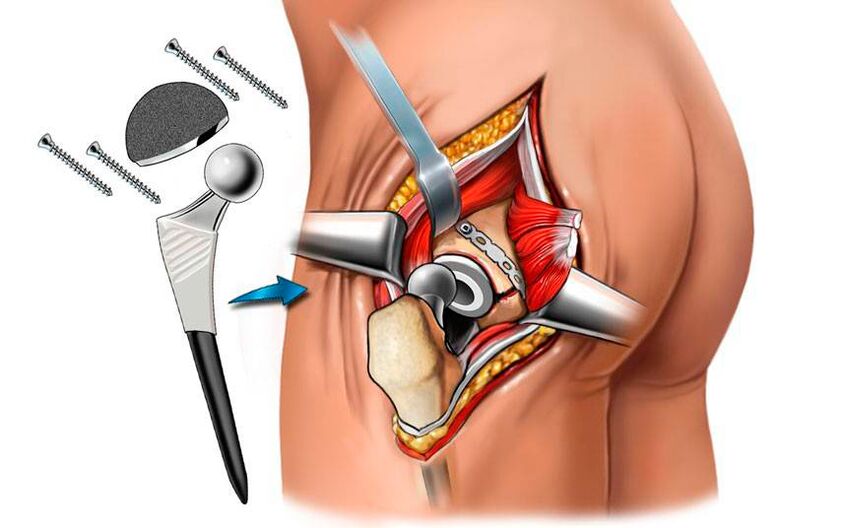 Inštalácia endoprotézy - chirurgické riešenie problému koxartrózy