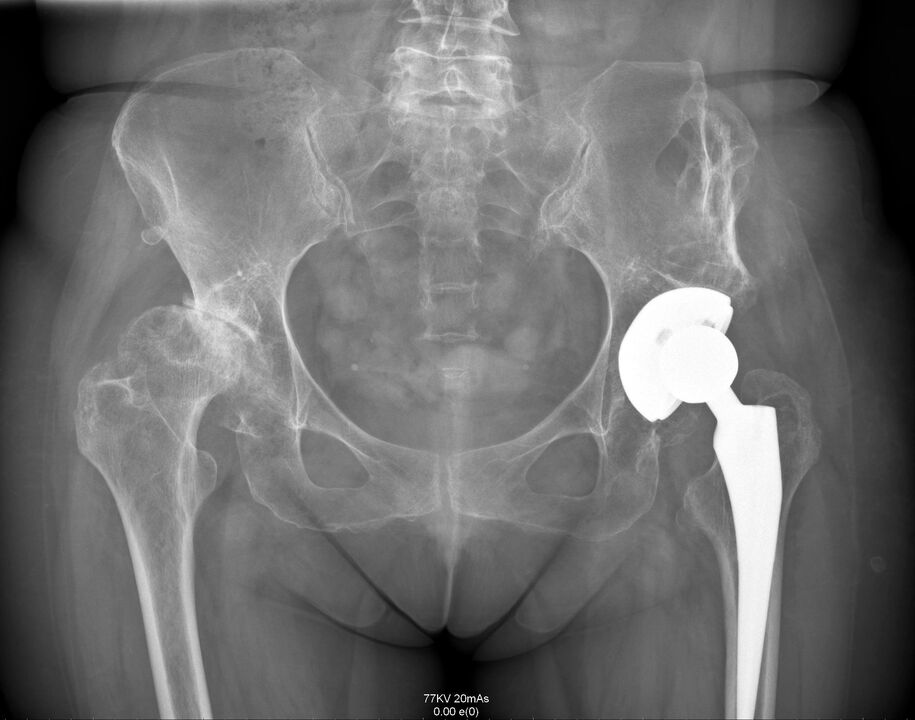 RTG bedrového kĺbu po artroplastike