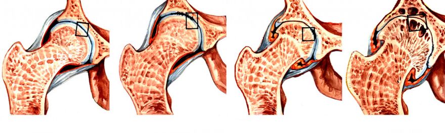 Stupeň vývoja koxartrózy bedrového kĺbu