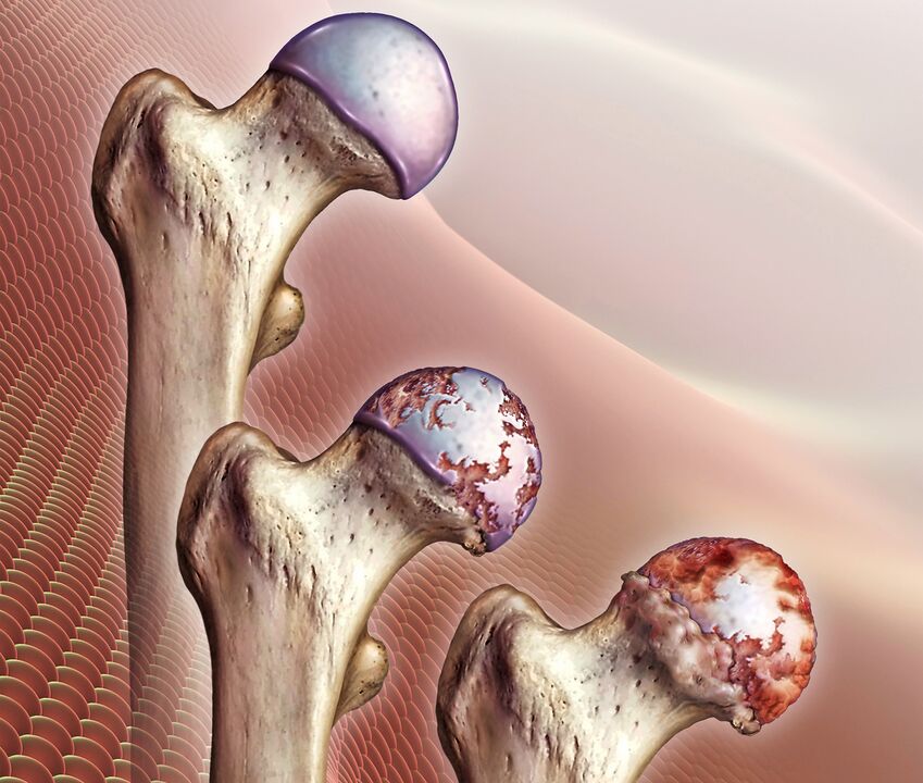 Vývoj artrózy bedrového kĺbu