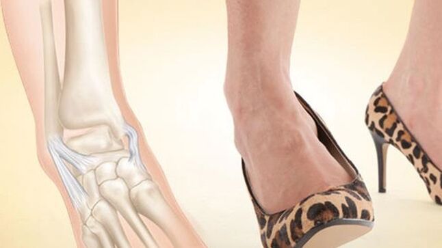 nosenie topánok s podpätkami ako príčina artrózy členku
