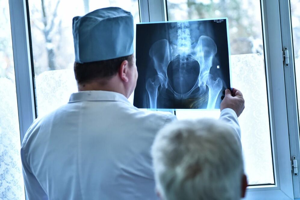 Lekár sa pozerá na obrázok bedrového kĺbu s artrózou