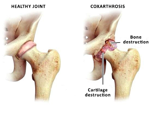 porovnanie zdravých kĺbov a hip sustave